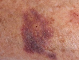 Les hématomes chez les personnes âgées : causes et prévention