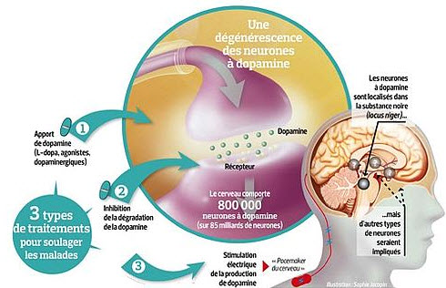 Parkinson : Les cellules souches pour combattre la maladie - Source de l'image : http://www.lefigaro.fr/