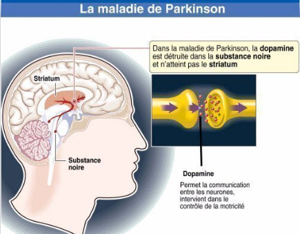 Parkinson : le tube digestif reflet du cerveau - Source de l'image : http://www.lesechos.fr/