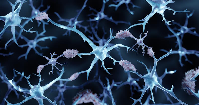 Modèle du cerveau avec des aggrégats de peptides amyloïdes dans la maladie d'Alzheimer