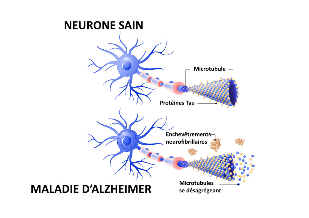 Schéma d'un neurone sain et d'un neurone dans la maladie d'Alzheimer, avec des enchevêtrements neurofibrillaires de protéine Tau