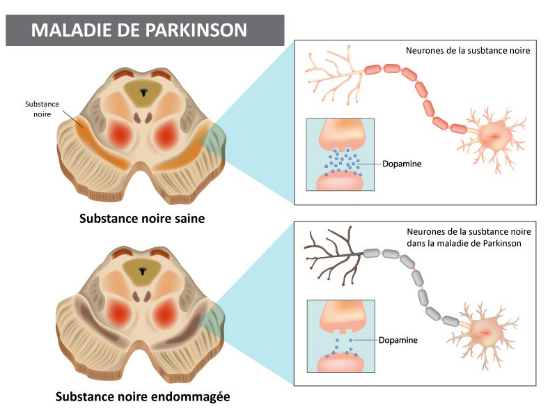 Schéma de la substance noire dans la maladie de Parkinson