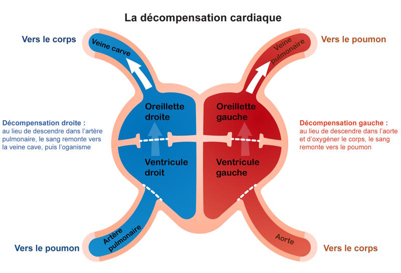 Schéma du flux sanguin inversé dans la décompensation cardiaque