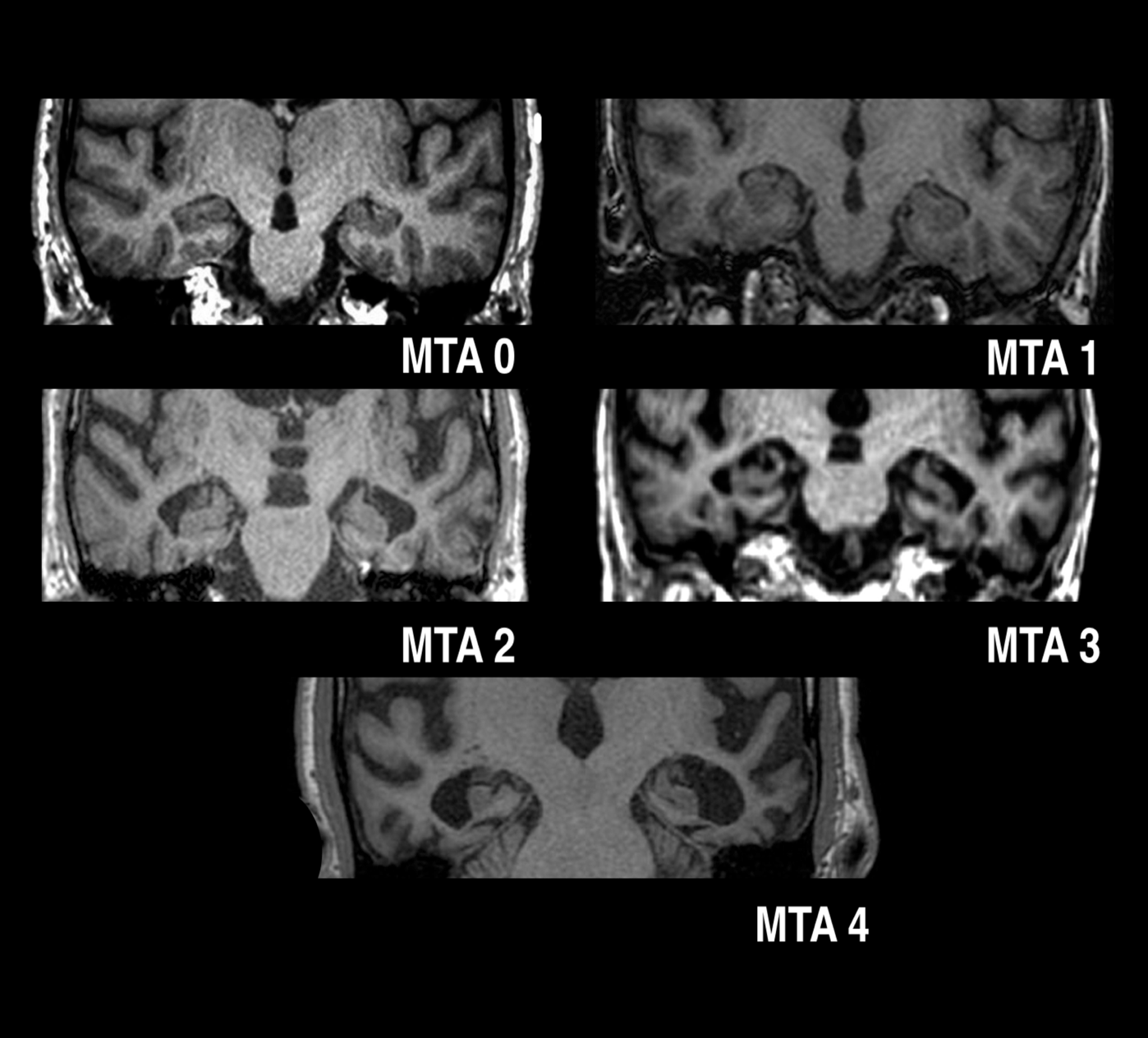 Images IRM des grades de l'échelle de Scheltens