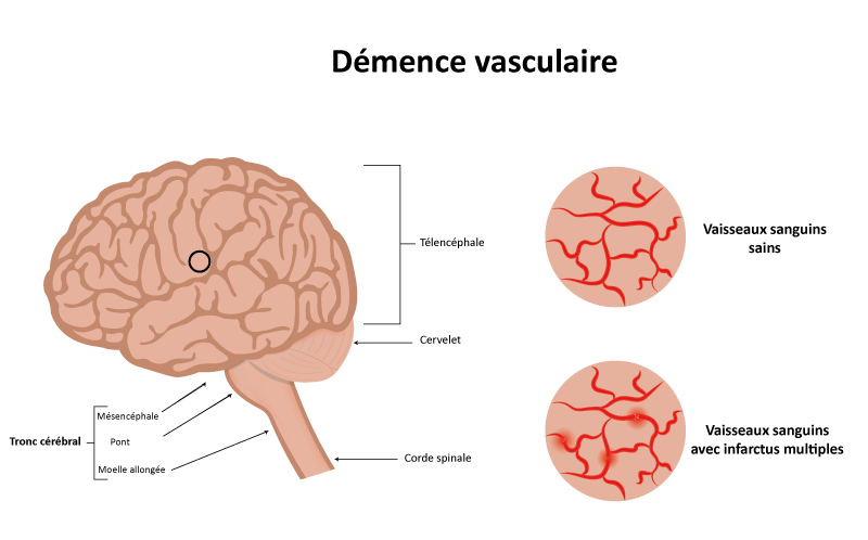 La D mence Vasculaire Sympt mes Diagnostic Et Traitement Cap Retraite La D mence Vasculaire Sympt mes Diagnostic Et Traitement Cap Retraite