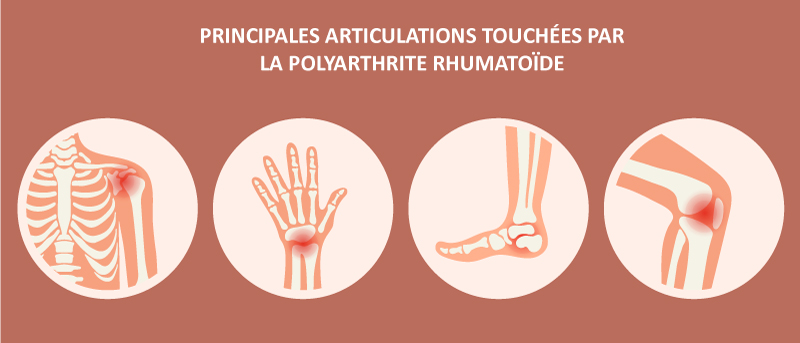 Les principales articulations atteintes par la polyarthrite rhumatoïde : main, pied, genou, épaule