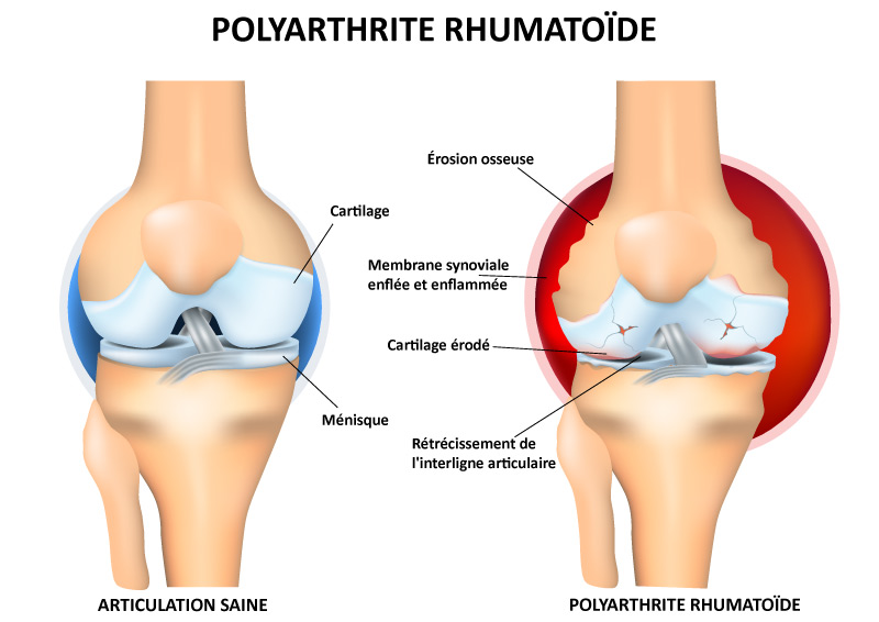 Schéma d'une articulation saine et d'une autre d'un genou touché par la polyarthrite rhumatoïde