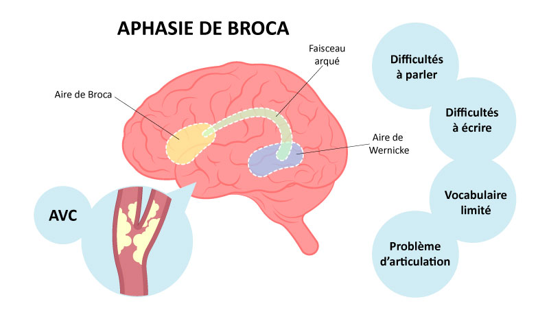 Schéma du cerveau dans l'aphasie de Broca