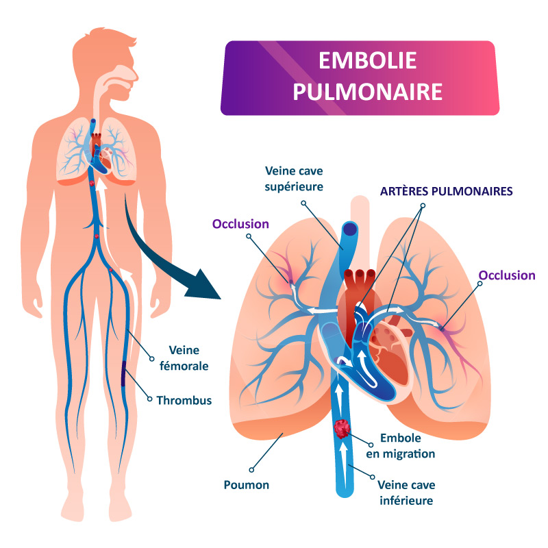Schéma décrivant la cause de l'embolie pulmonaire