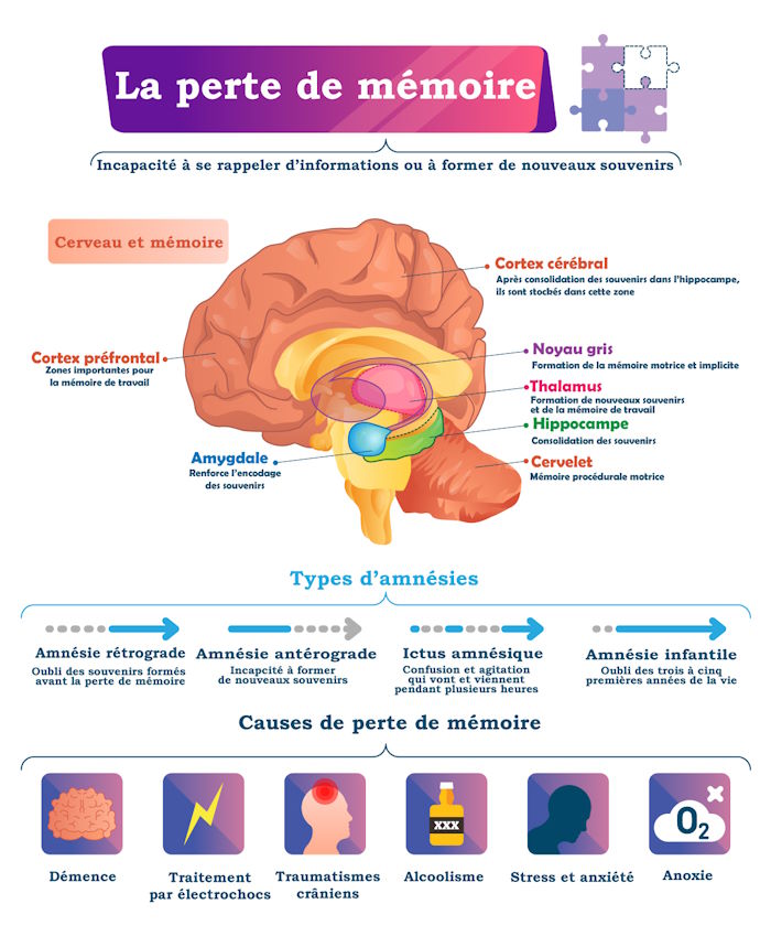 Infographie sur la perte de mémoire et ses mécanismes dans le cerveau, ses causes de ces troubles mnésiques et cognitifs et les types d'amnésie
