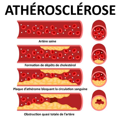 Maladie Cardiovasculaire Causes Risques Et Pr vention