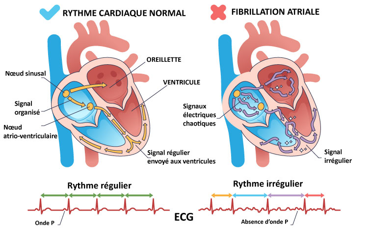 Schéma de la fibrillation auriculaire : la principale arythmie cardiaque