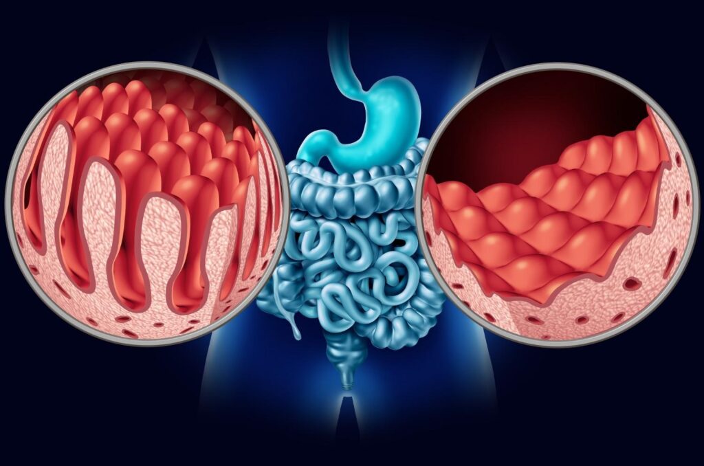 comprendre la maladie de Crohn