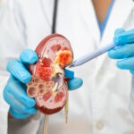 Médecin tenant un modèle de rein pour illustrer la baisse du débit de filtration glomérulaire (DFG)