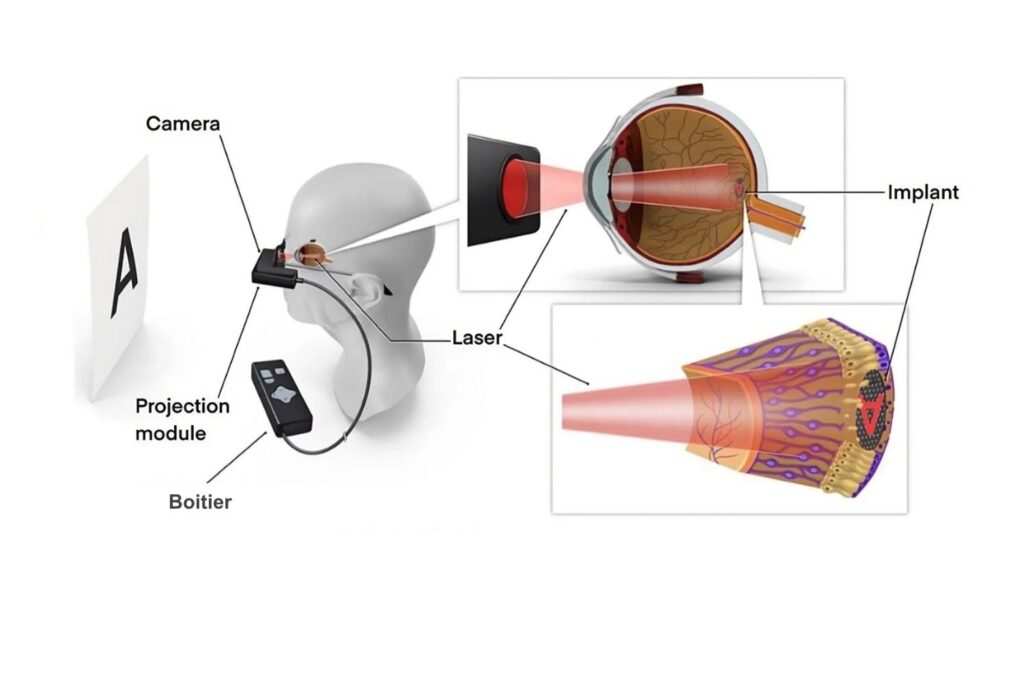 traitement DMLA sèche 