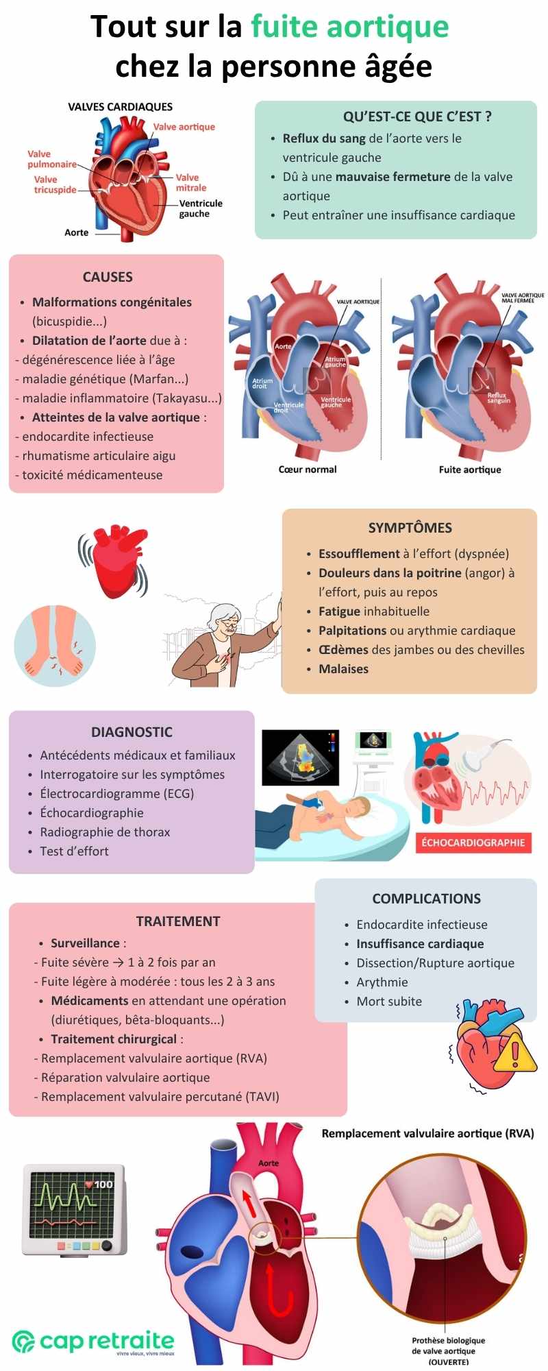 Infographie sur la fuite aortique (insuffisance aortique) : causes, symptômes, diagnostic et traitement