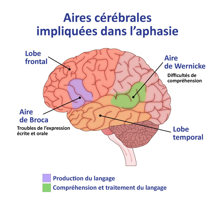 Schéma des aires cérébrales impliquées dans l'aphasie de Broca et dans celle de Wernicke